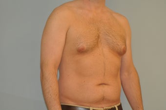 25-34 year old man treated with Male Breast Reduction 3125521