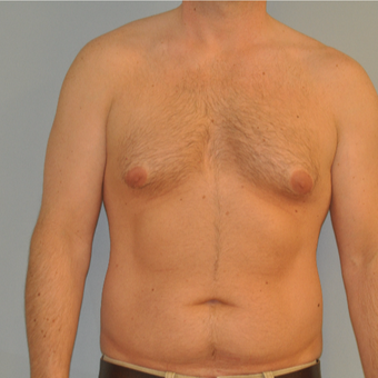 25-34 year old man treated with Male Breast Reduction before 3125521