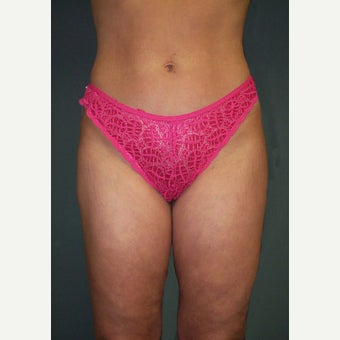 35-44 year old woman treated with Vaser Liposuction after 2136842
