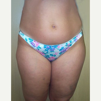 35-44 year old woman treated with Vaser Liposuction before 2136842