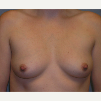 25-34 year old woman treated with Breast Implants before 3175538