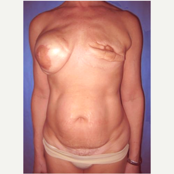 57 year old woman treated with DIEP flap Breast Reconstruction Revision before 3725105