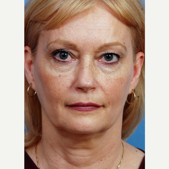 55-64 year old woman treated with Upper and Lower Eyelid Surgery before 3658120