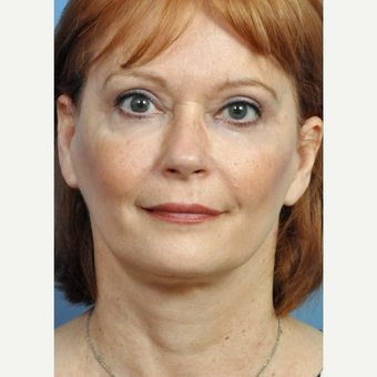 55-64 year old woman treated with Upper and Lower Eyelid Surgery after 3658120