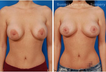 Repair of Botched Breast Lift with Reduction of Areolae before 902732