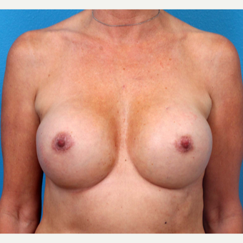 35-44 year old woman treated with Breast Implant Revision after 3371234