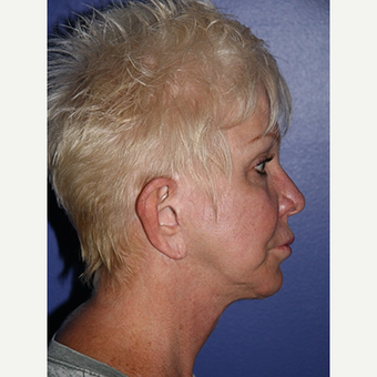 59 year old woman treated with Facelift before 3710776