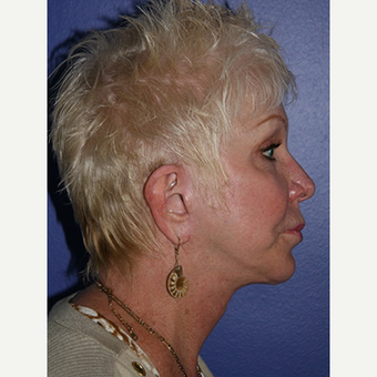 59 year old woman treated with Facelift after 3710776