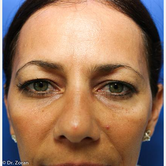 35-44 year old woman treated with Eyelid Surgery before 3093770