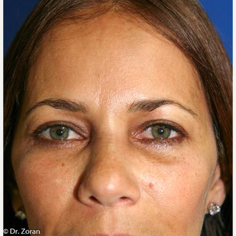 35-44 year old woman treated with Eyelid Surgery after 3093770