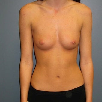 18-24 year old woman treated with Breast Augmentation before 1713303