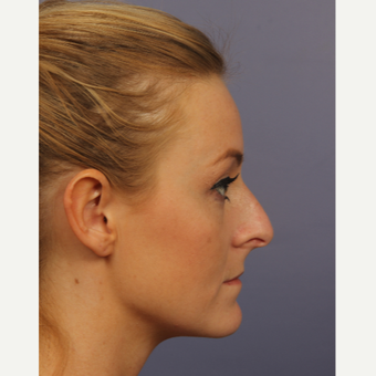 18-24 year old woman treated with Rhinoplasty before 3502707