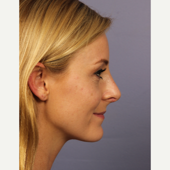 18-24 year old woman treated with Rhinoplasty after 3502707
