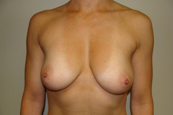 Breast Augmentation before 209892