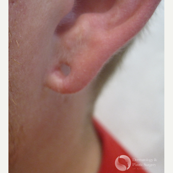25-34 year old man treated with Ear Lobe Surgery before 3325442