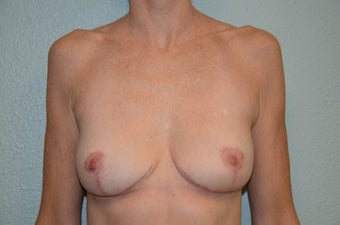Removal of Breast Implants and Breast Lift after 1316171