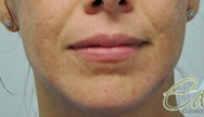 25-34 year old woman treated with Microneedling before 2291640