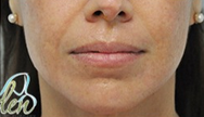 25-34 year old woman treated with Microneedling after 2291640