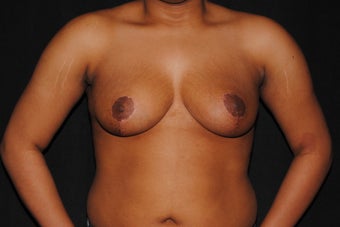 19 year old woman dissatisfied with her saggy breasts after 1280030