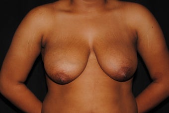 19 year old woman dissatisfied with her saggy breasts before 1280030