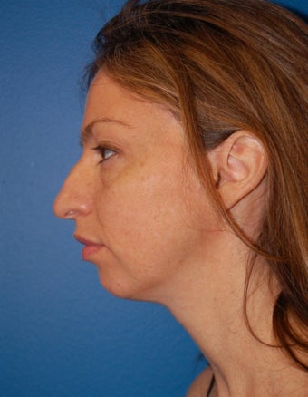 Chin Augmentation before 902806