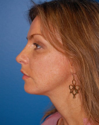 Chin Augmentation after 902806