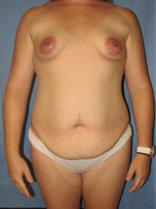 35-44 year old woman treated with Mommy Makeover before 3003918