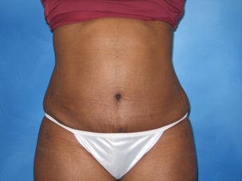 Abdominoplasty and Liposuction of Flanks after 1189948