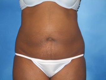 Abdominoplasty and Liposuction of Flanks before 1189948