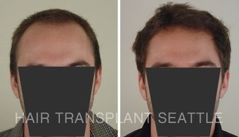 25-34 year old man treated with Hair Transplant before 1578502
