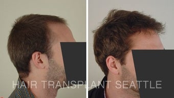 25-34 year old man treated with Hair Transplant 1578502