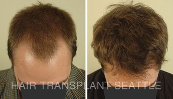 25-34 year old man treated with Hair Transplant after 1578502