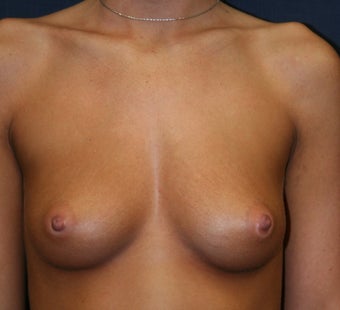 Breast Augmentation - Gel Implants before 510475