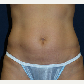 45-54 year old woman treated with Tummy Tuck after 3453682