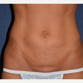 45-54 year old woman treated with Tummy Tuck before 3453682