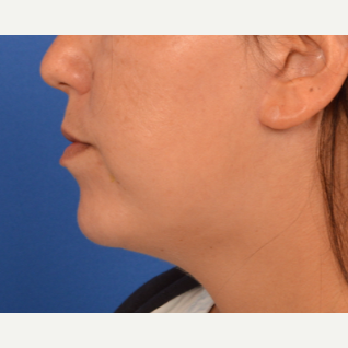 Chin Implant, submental liposuction and buccal fat removal after 3220645
