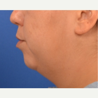 Chin Implant, submental liposuction and buccal fat removal before 3220645