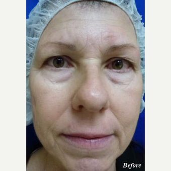 57 year old woman treated with Liquid Facelift before 3710050
