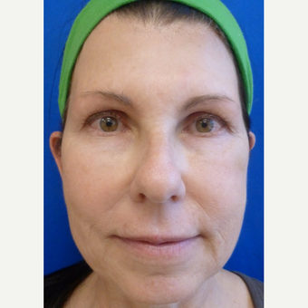 57 year old woman treated with Liquid Facelift after 3710050