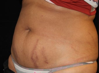 25-34 year old woman treated with SculpSure 3501971