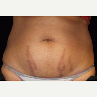 25-34 year old woman treated with SculpSure before 3501971
