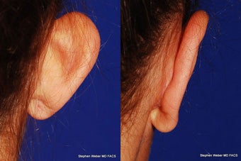 Ear Surgery before 1445755