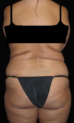 45 year old woman treated with Liposuction 3251644