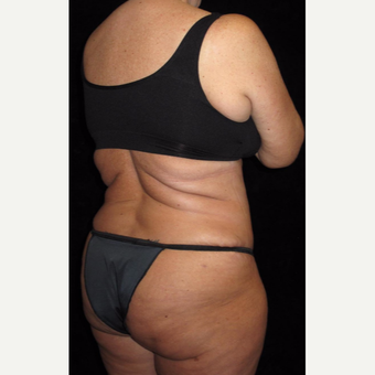 45 year old woman treated with Liposuction after 3251644