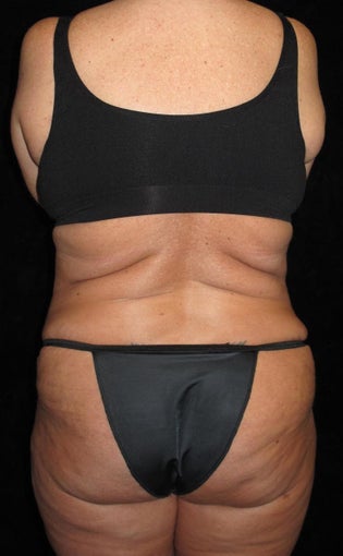 45 year old woman treated with Liposuction 3251644
