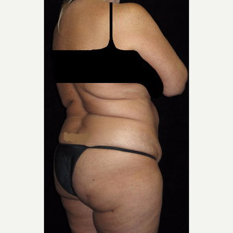 45 year old woman treated with Liposuction before 3251644