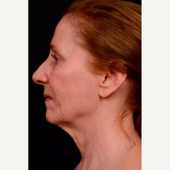 55-64 year old woman treated with Facelift before 3663584