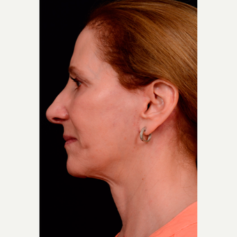 55-64 year old woman treated with Facelift after 3663584
