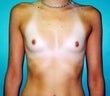 20 year old female patient before 943855