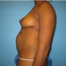 25-34 year old woman treated with Mommy Makeover before 3293500